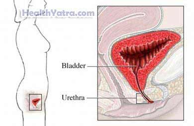 Urethral Syndrome