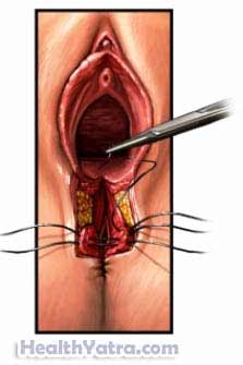 Vaginal Laceration