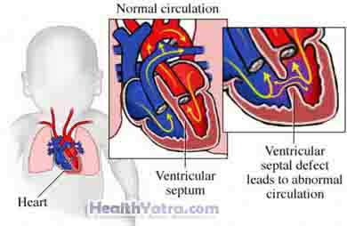 Ventricular Septal খুঁত