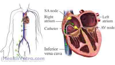 Ventricular Septal Defect1