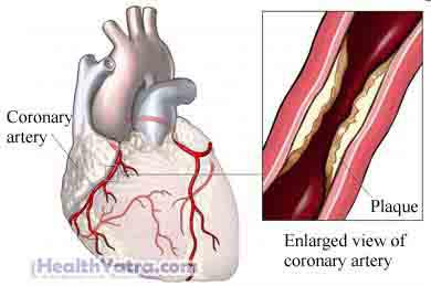 Ventricular Tachycardia2