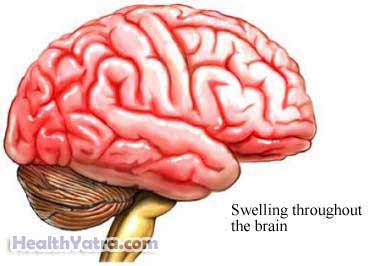تعريف التهاب الدماغ الخيلي الغربي والأسباب والأعراض والمضاعفات وتكلفة العلاج الجراحي في الهند