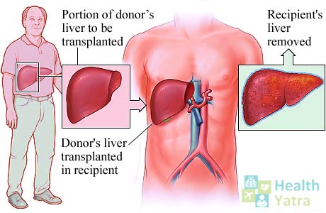 History of Liver Transplantation & Cost Treatment in India