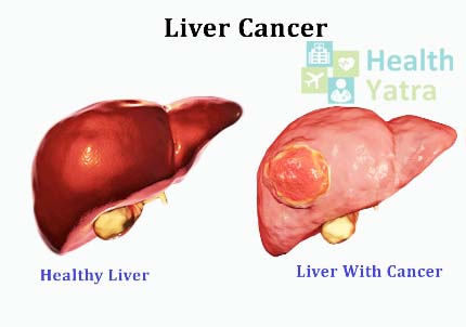 سرطان الكبد يصاب مرضى تليف الكبد بأورام الكبد