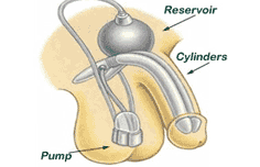 Penile Implant Surgery in India
