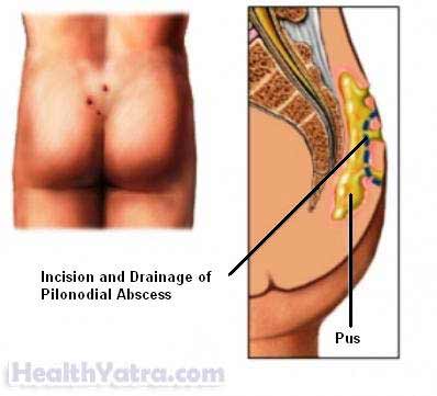 Best Cost Incision and Drainage of a Skin Abscess Surgery, Treatment Hospital in India