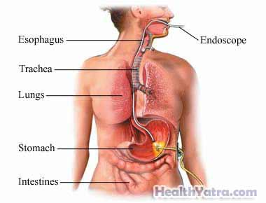 Best Cost Percutaneous Endoscopic Gastrostomy Surgery, Treatment Hospital in India