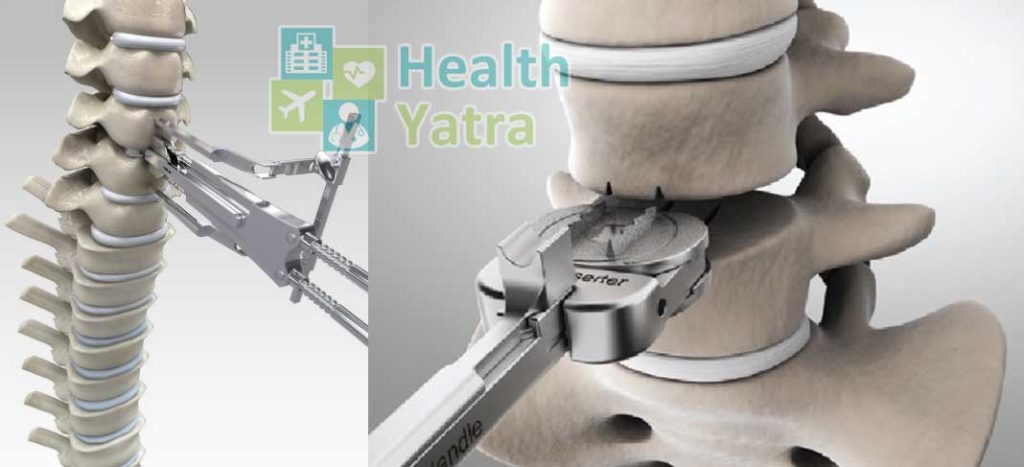 Artificial Disc Replacement Surgery in India