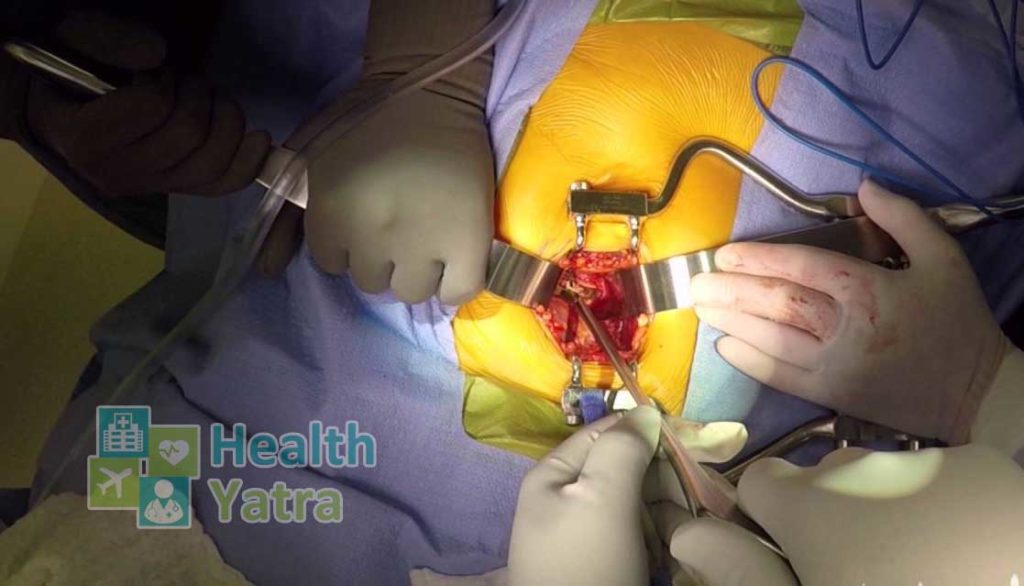 ما هي إجراءات جراحة استبدال القرص الاصطناعي