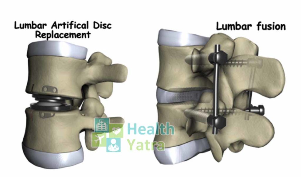 Artificial Disc Replacement Surgery Cost in India