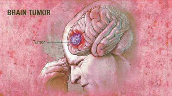 Brain Tumor Surgery, Cost Treatment Surgery Top Hospital Best Doctors in India