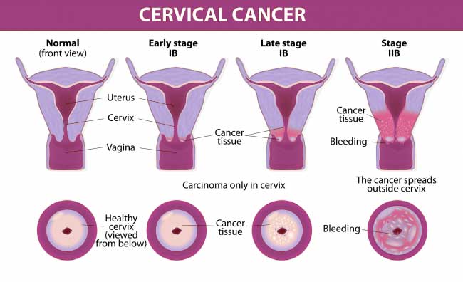 Cervical Cancer Cost Treatment Surgery Top Hospital Best Doctors in India