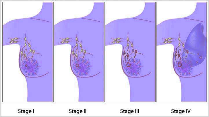 स्तन कैंसर के चरण