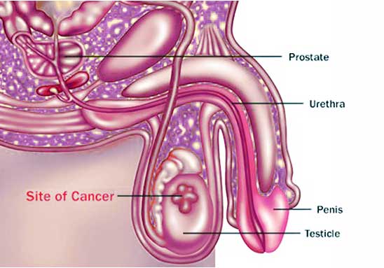 cancer prostata rmn forum mâncărime în timpul prostatitei
