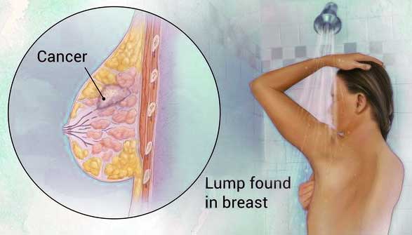 A cancer that forms in the cells of the breasts.