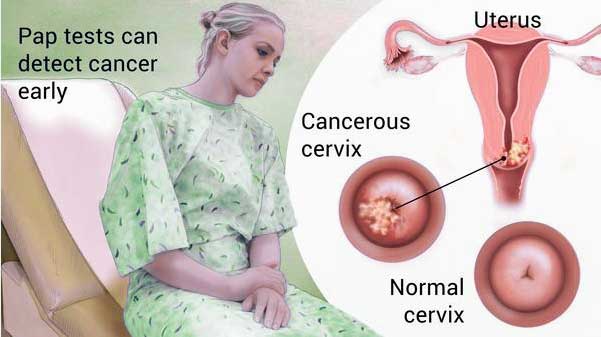 سرطان عنق الرحم ، جراحة علاج التكلفة أفضل الأطباء في الهند