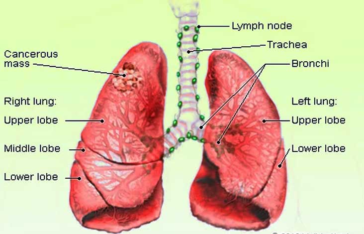Lung Cancer Treatment Surgery India