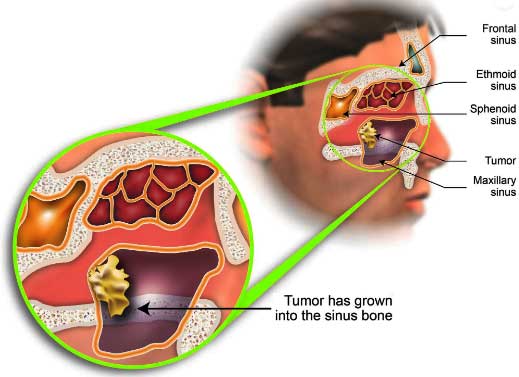 Nasal Cavity Cancer, Cost Treatment Surgery Top Hospital Best Doctors in India
