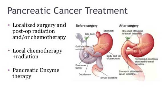 Pancreatic Cancer Surgery Before After