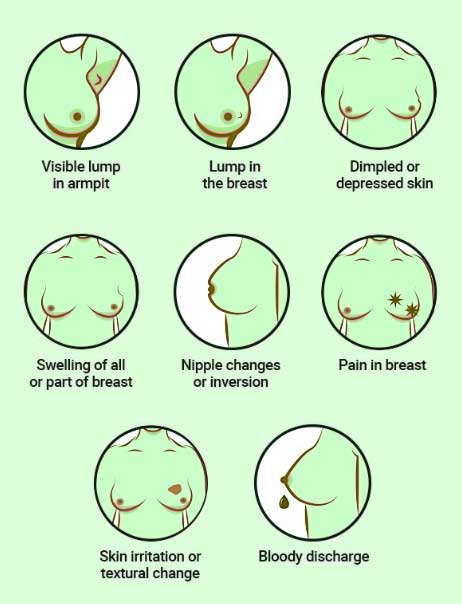 Infographic of Sign and Symptoms of Breast Cancer