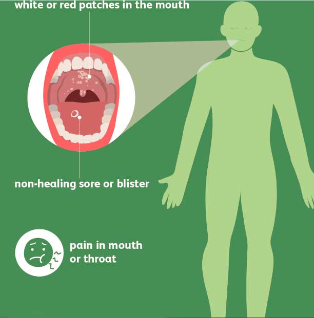 Sign and Symptoms of Oral cancer and Treatment in India