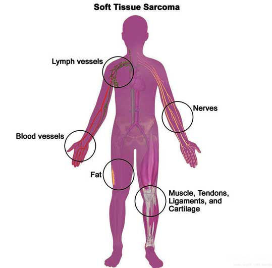 Sarcoma Cancer, Cost Treatment Surgery Top Hospital Best Doctors in India