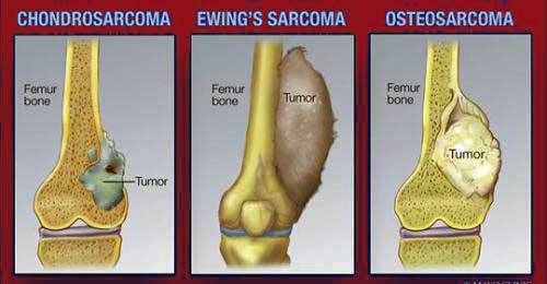 Types of Bone Cancer and Treatment in India