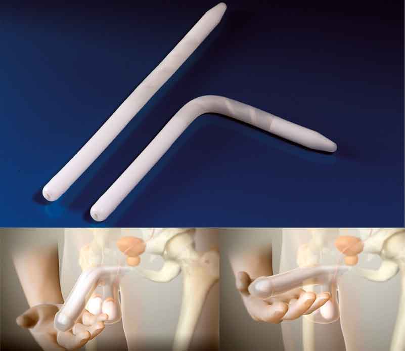 Malleable Penile Prosthesis Surgery in India