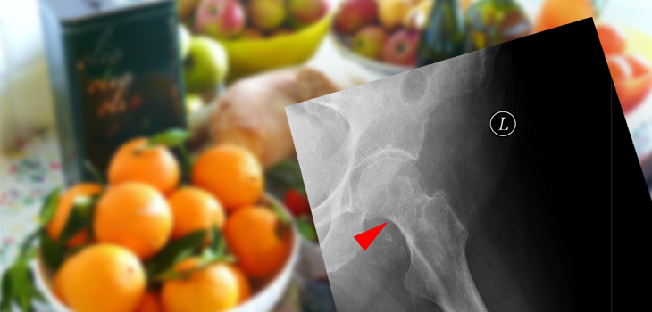 Lower Risk Of Hip Fracture With Mediterranean Diet