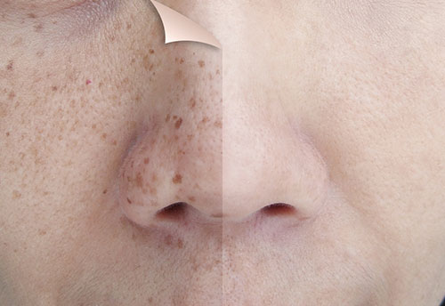 Prevent and Treat Remove Skin Pigmentation