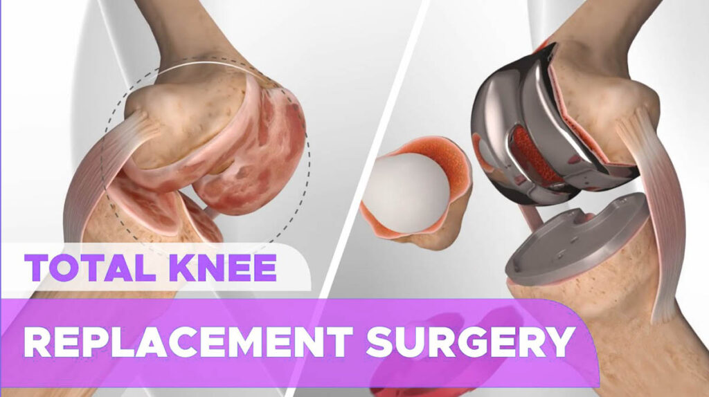 Affordable Revision Total Knee Replacement Surgery in India