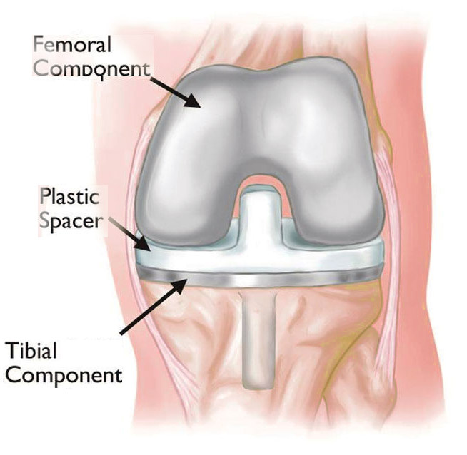 प्राथमिक संपूर्ण घुटना प्रतिस्थापन सर्जरी के दौरान प्राकृतिक घुटने के जोड़ को कृत्रिम अंग या प्रत्यारोपण से बदल दिया जाता है