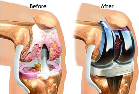Reasons to Undergo Total Knee Replacement Surgery in India