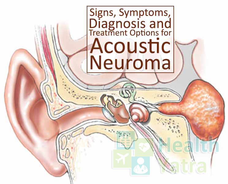 Acoustic Neuroma Treatment in India