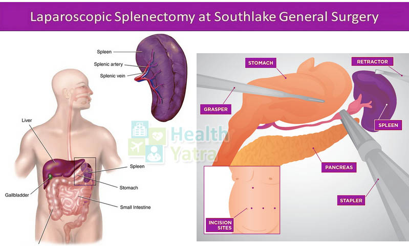 Advanced and Affordable Splenectomy in India