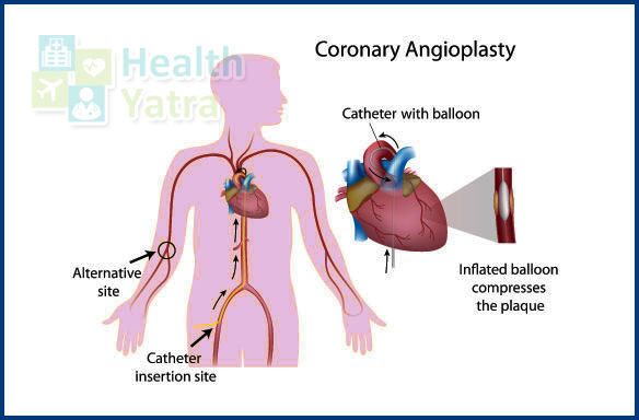 Affordable Coronary Balloon Angioplasty Stent Placement Procedure Cost in India