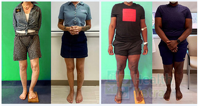 भारत में अंग की लंबाई विसंगति का उपचार