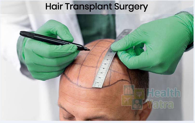 Affordable Hair Transplantation Surgery in India with HealthYatra
