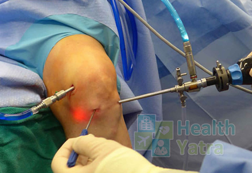 भारत में घुटने की आर्थ्रोस्कोपी सर्जरी की किफायती लागत
