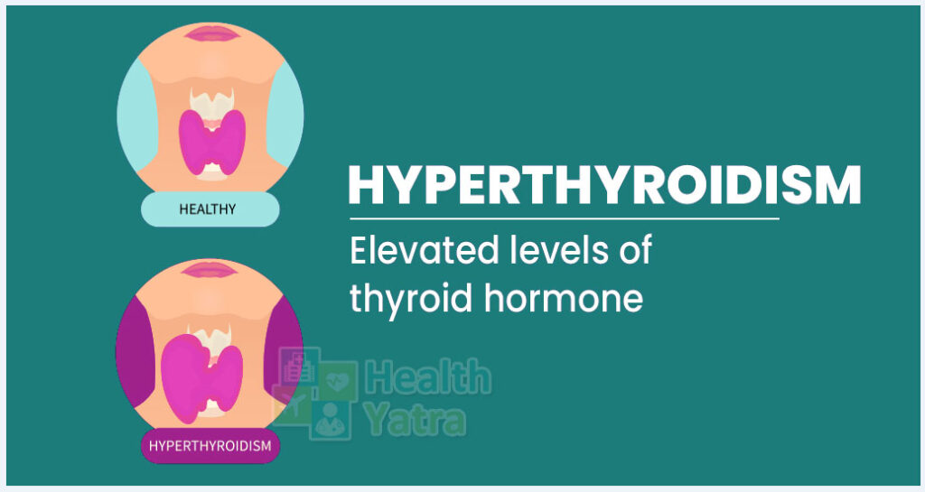 Affordable Medical Care for Hyperthyroidism or Overactive Thyroid in India
