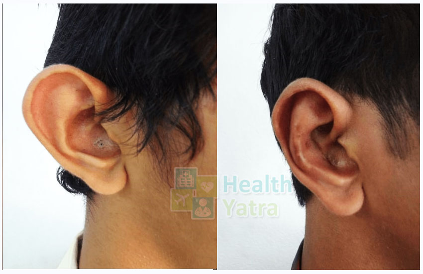 جراحة تجميل الأذن بأسعار معقولة في الهند