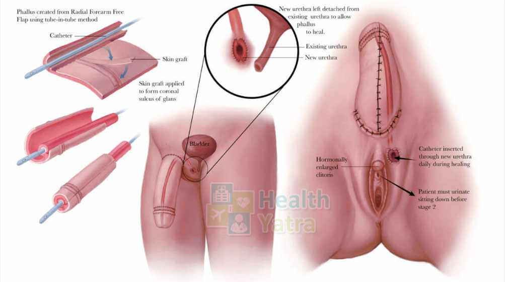 Affordable Phalloplasty Surgery in India