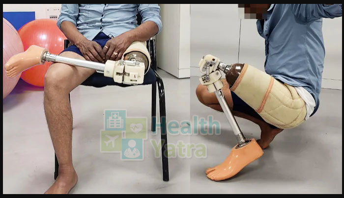Affordable Prosthetic Limb Surgery in India