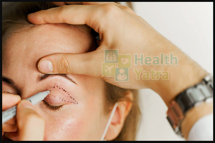 Affordable Ptosis Surgery in India for Drooping Eyelids