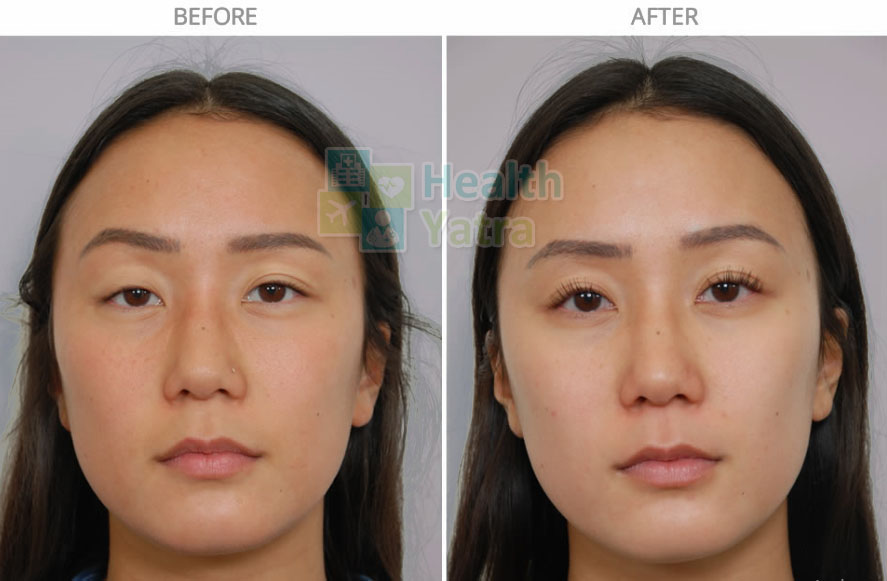 Affordable Ptosis Surgery in India with HealthYatra