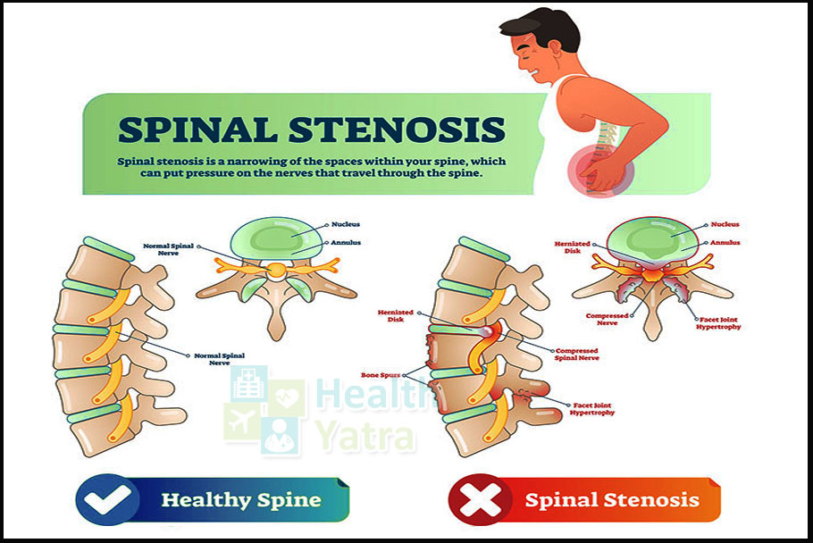 Affordable Spinal Stenosis Treatment in India to Improve Your Quality of Life HealthYatra