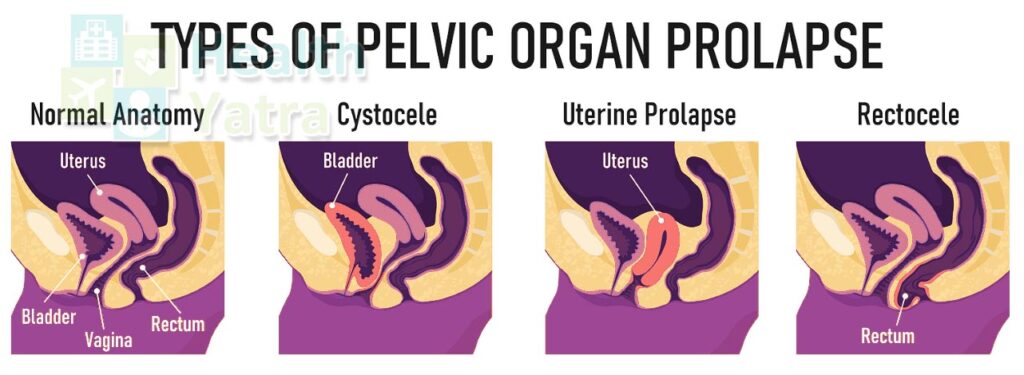 Affordable Surgery in India for Pelvic Organ Prolapse