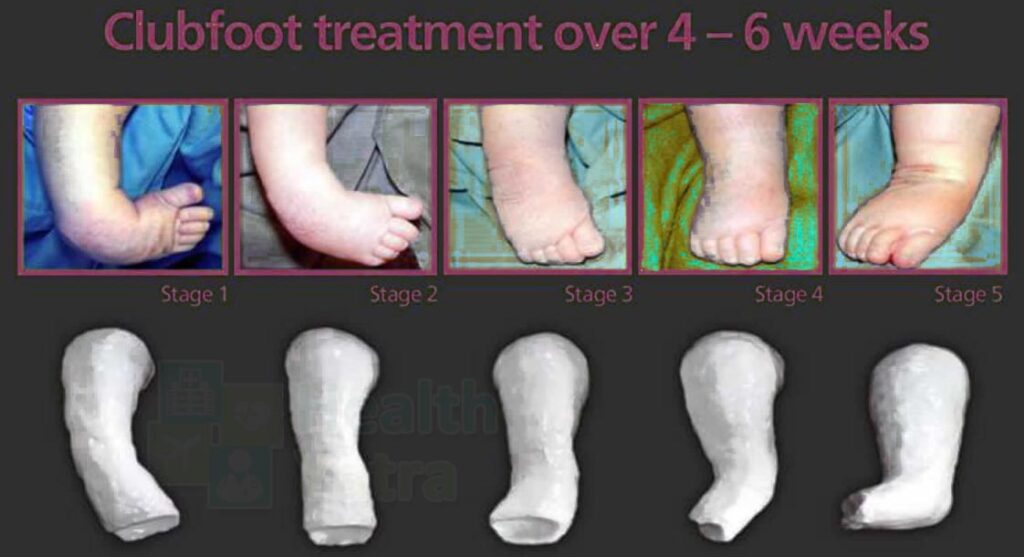Affordable Treatment for clubfoot in India