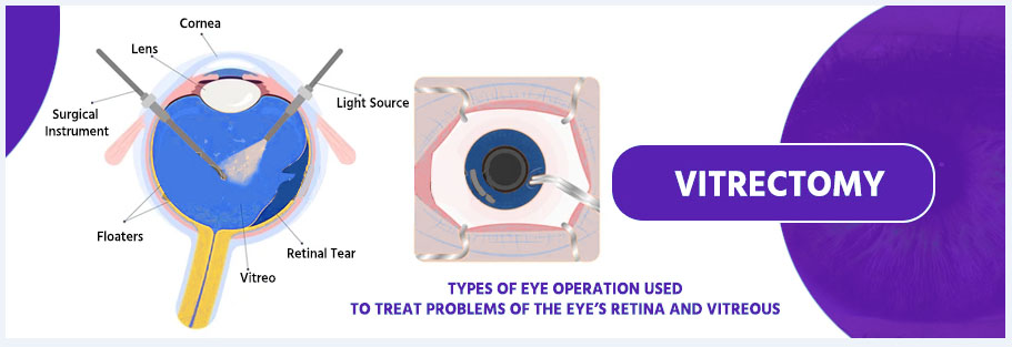 Affordable Vitrectomy Eye Surgery In India for Severe Vitreous Hemorrhage