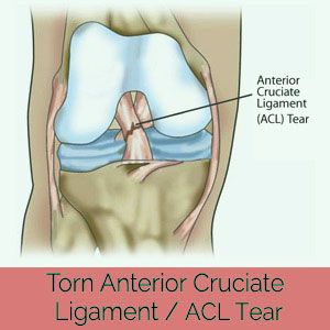 Anterior cruciate ligament tears Treatment india